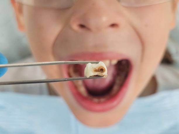 Best Emergency Wisdom Teeth Removal in St Pete Beach, FL